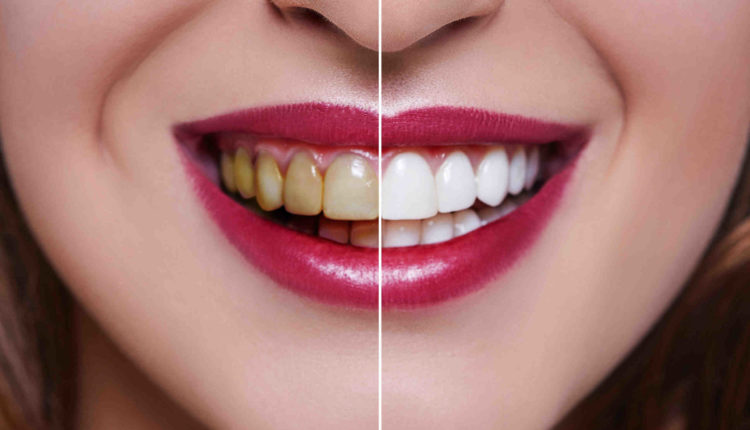 Do veneers last forever?