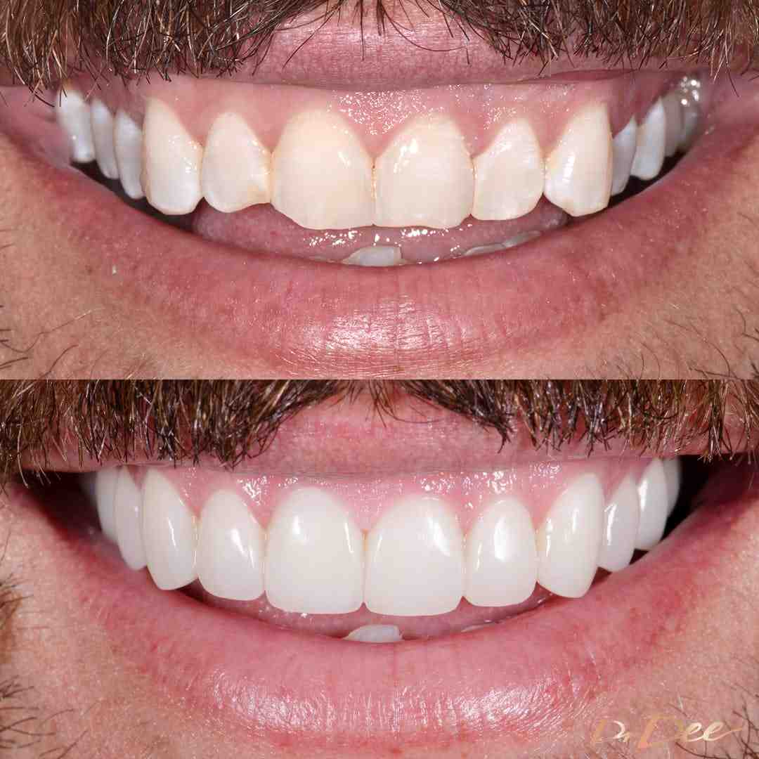 do-you-need-straight-teeth-before-veneers-dental-news-network