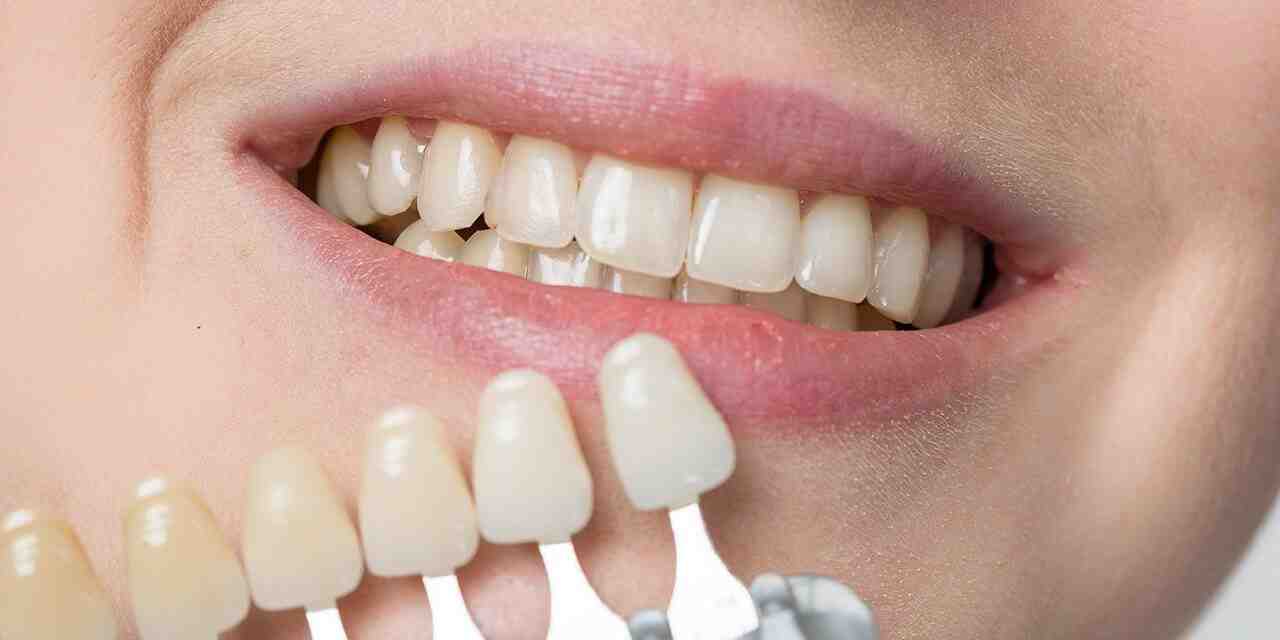Do veneers need maintenance?