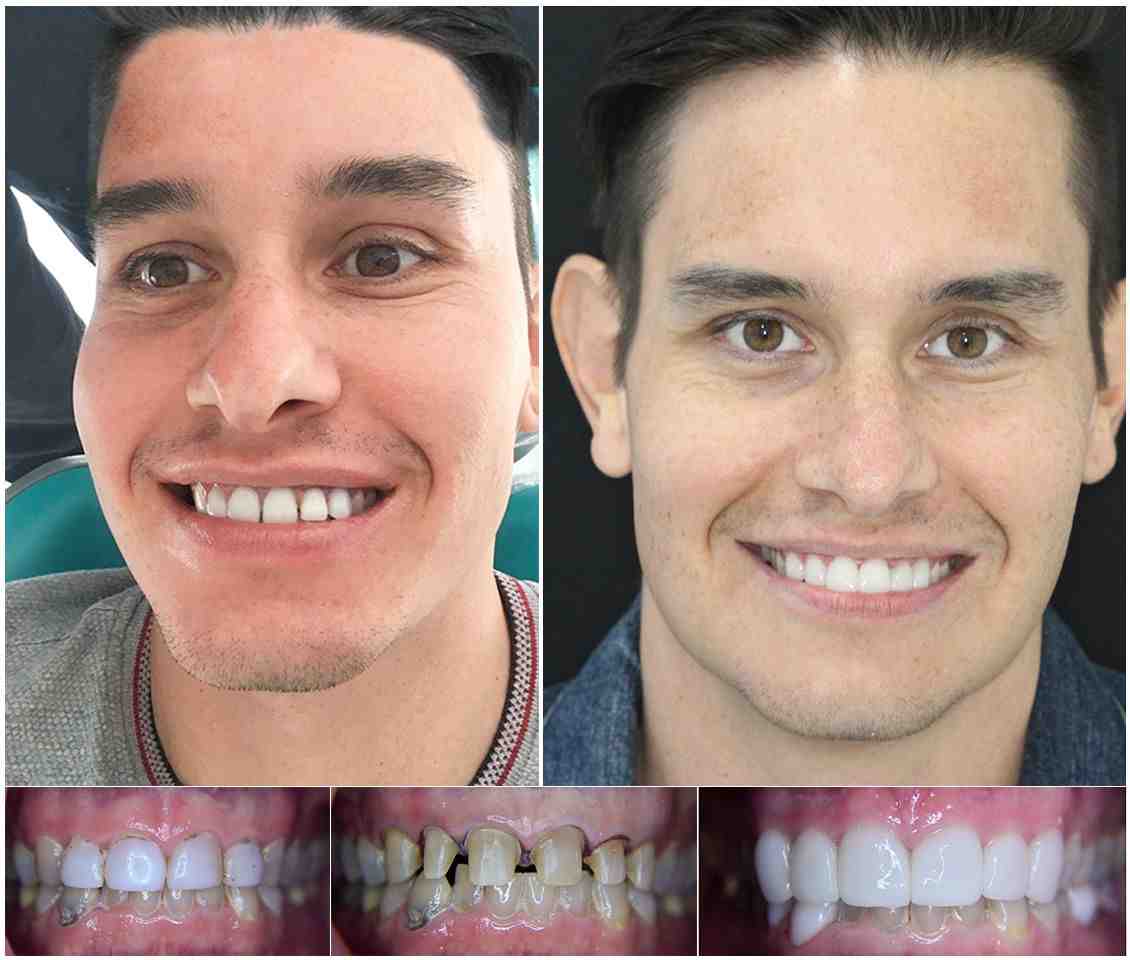 How much is it to get veneers in Mexico? Dental News Network