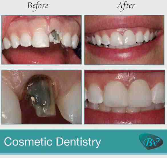 Do veneers stay white?