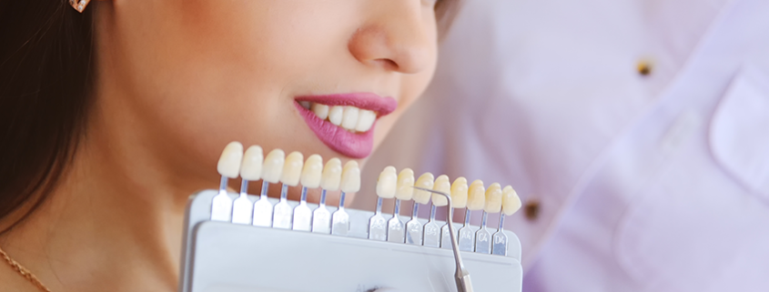 Do veneers stay white?