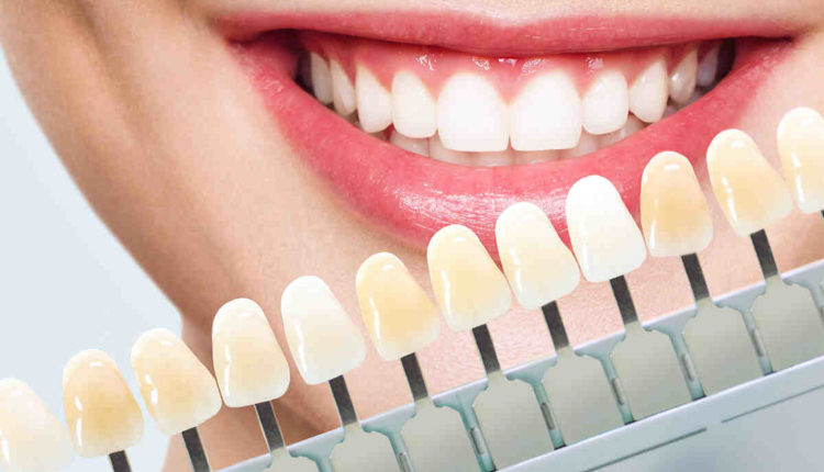 Do you brush veneers?