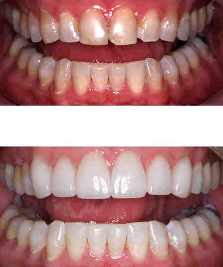 Do you brush veneers?