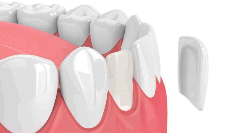 Do you have to brush veneers?