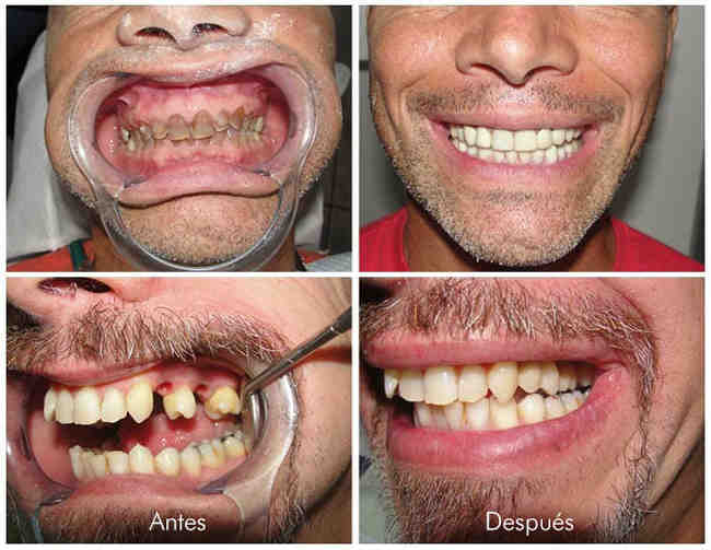 Can you get dental implants in mexico? Dental News Network