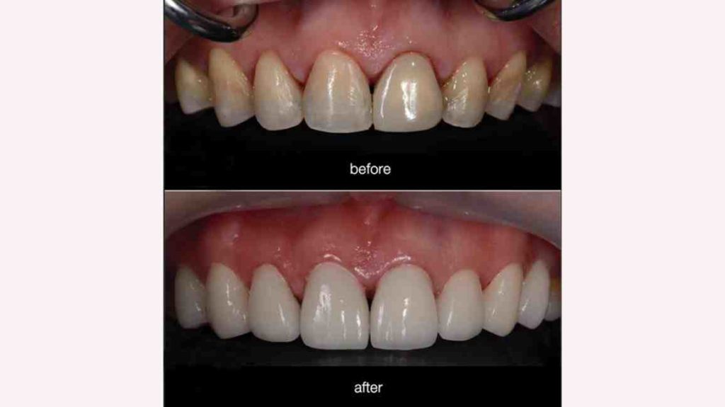 Do you have to shave your teeth down to get veneers? Dental News Network