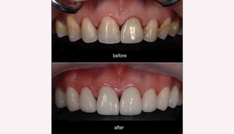 Do you have to shave your teeth down to get veneers?