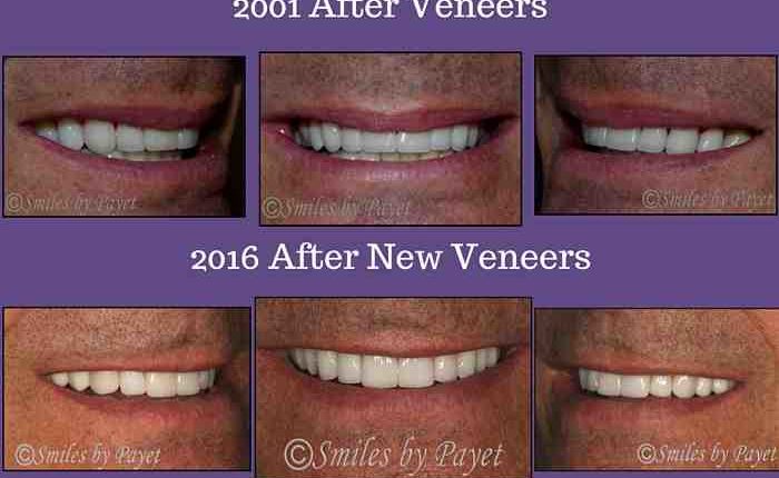 Do your teeth rot under veneers?