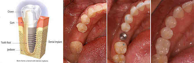 Does bone grow around dental implants?
