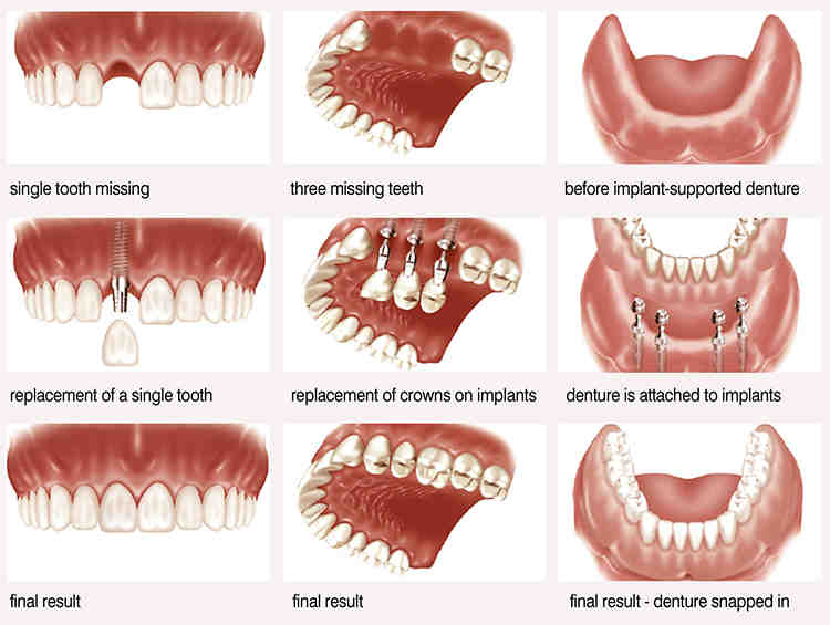 Does losing teeth change your face?