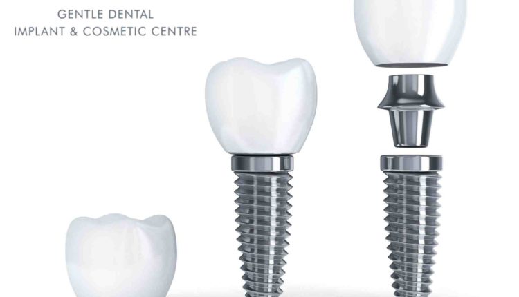 Does private health insurance cover dental implants