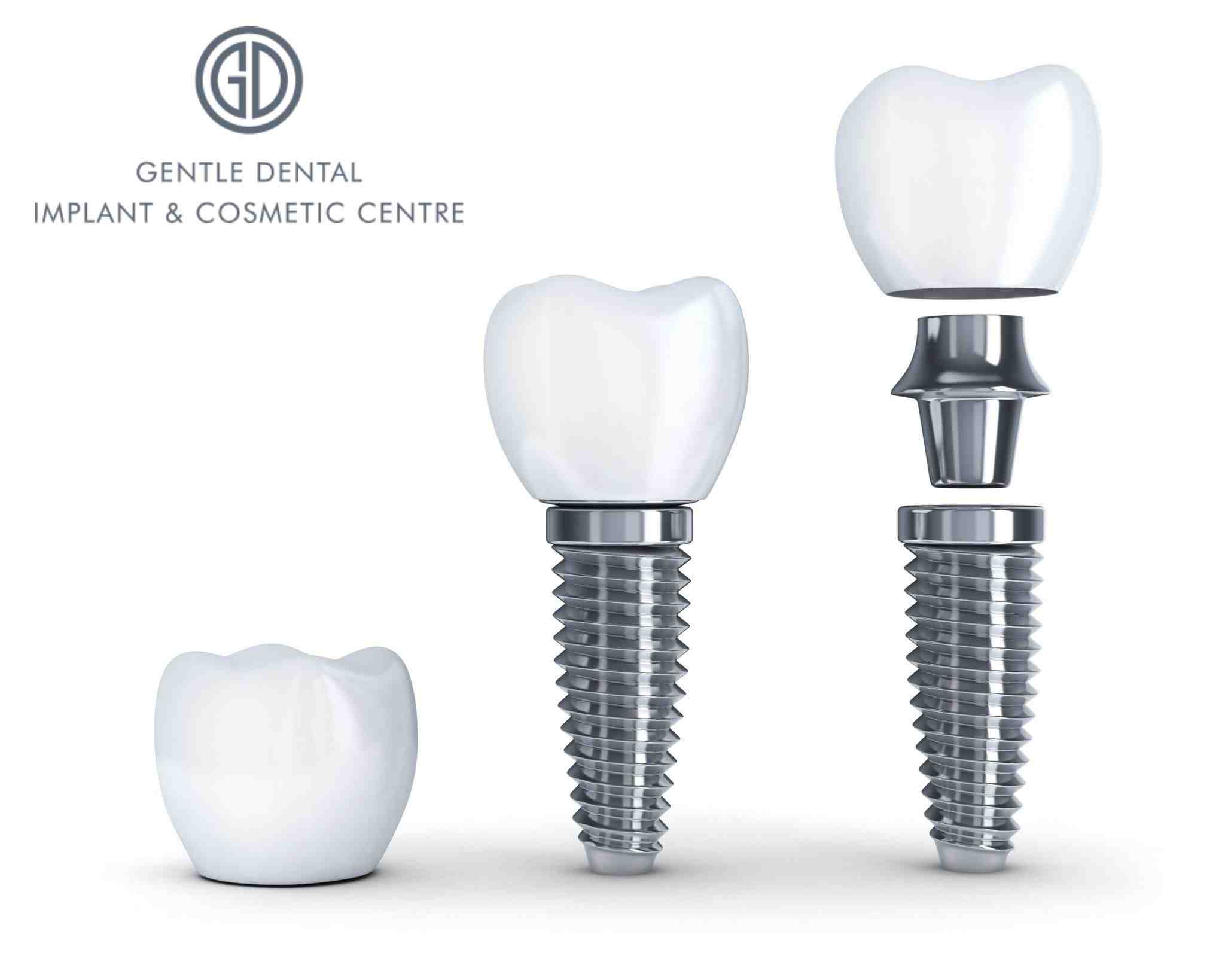 does sun life insurance cover dental implants