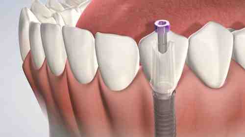 Does the abutment screw into the implant?