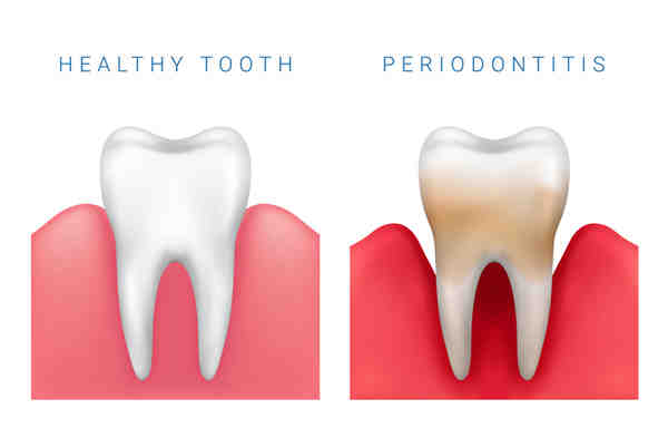 For what reason would an implant be contradicted?