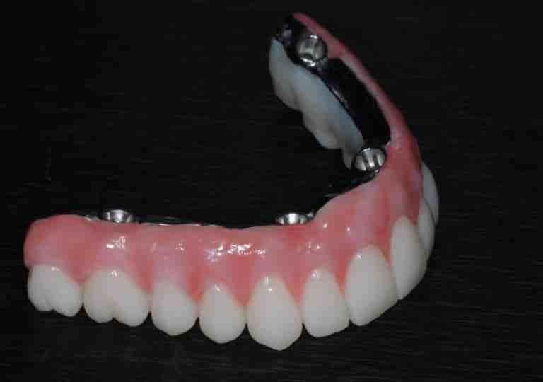 How are failed dental implants removed?