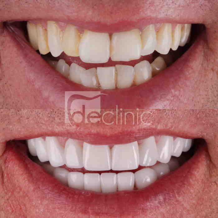 How can you tell if someone has veneers?