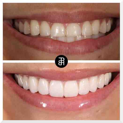 Do you have to shave your teeth down to get veneers? Dental News Network