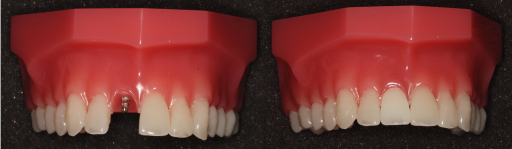 How do mini implants look?