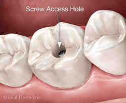 How do they attach a permanent crown?