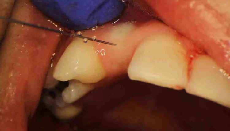 How do they uncover dental implants
