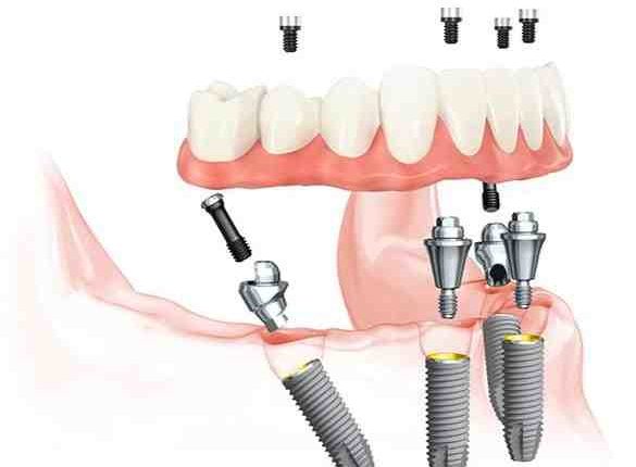How do top false teeth stay in place?
