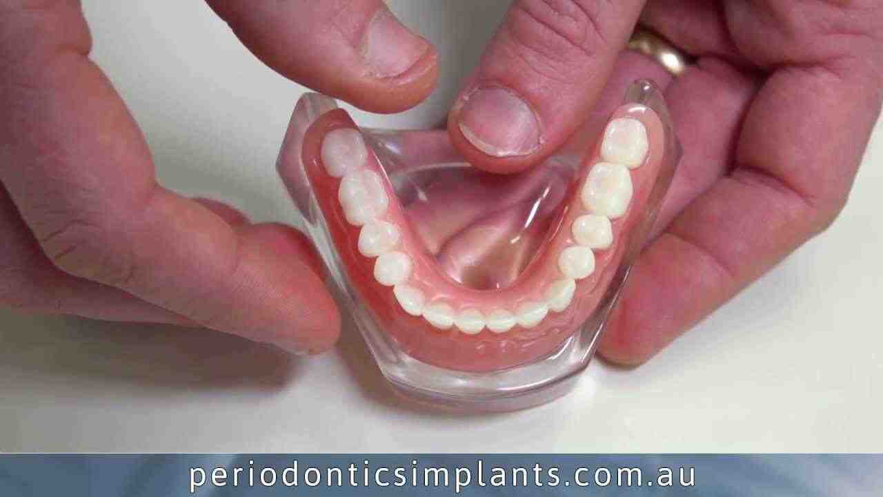 How do you clean your teeth with dental implants?