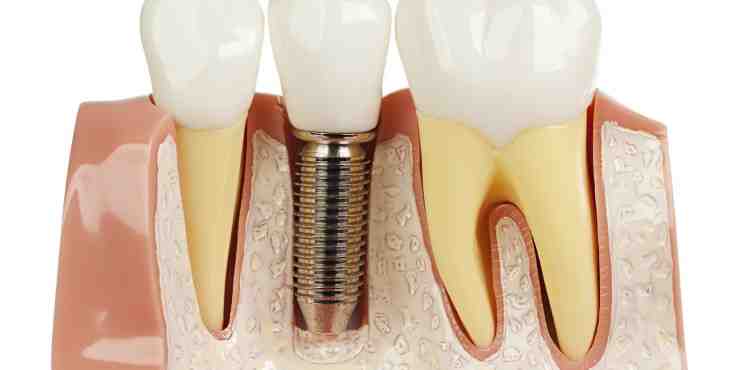 Titanium dental implants and metal reaction like hip? - Dental News Network