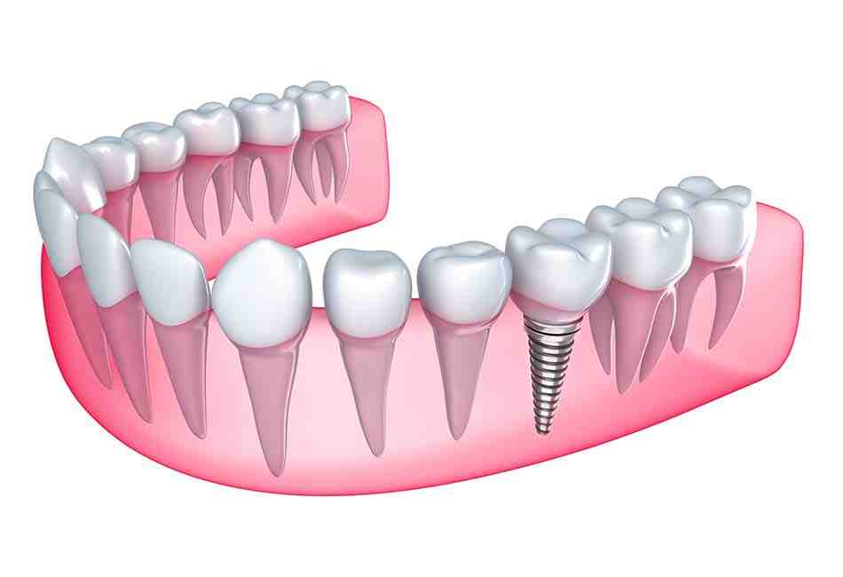 How do you pay for braces monthly?