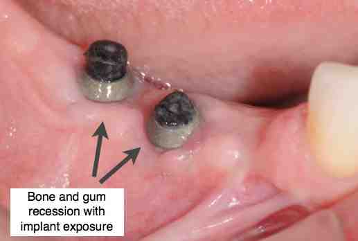 How do you treat an infected implant?