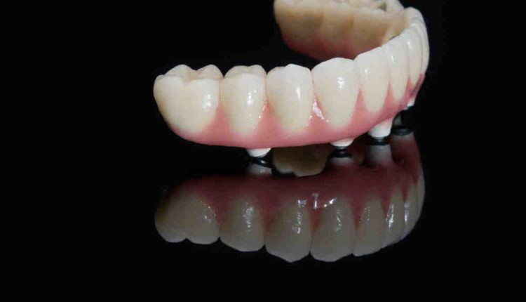How does archpoint do dental implants in only one day