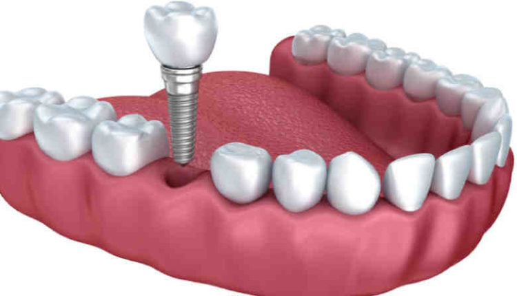 How durable are dental implants