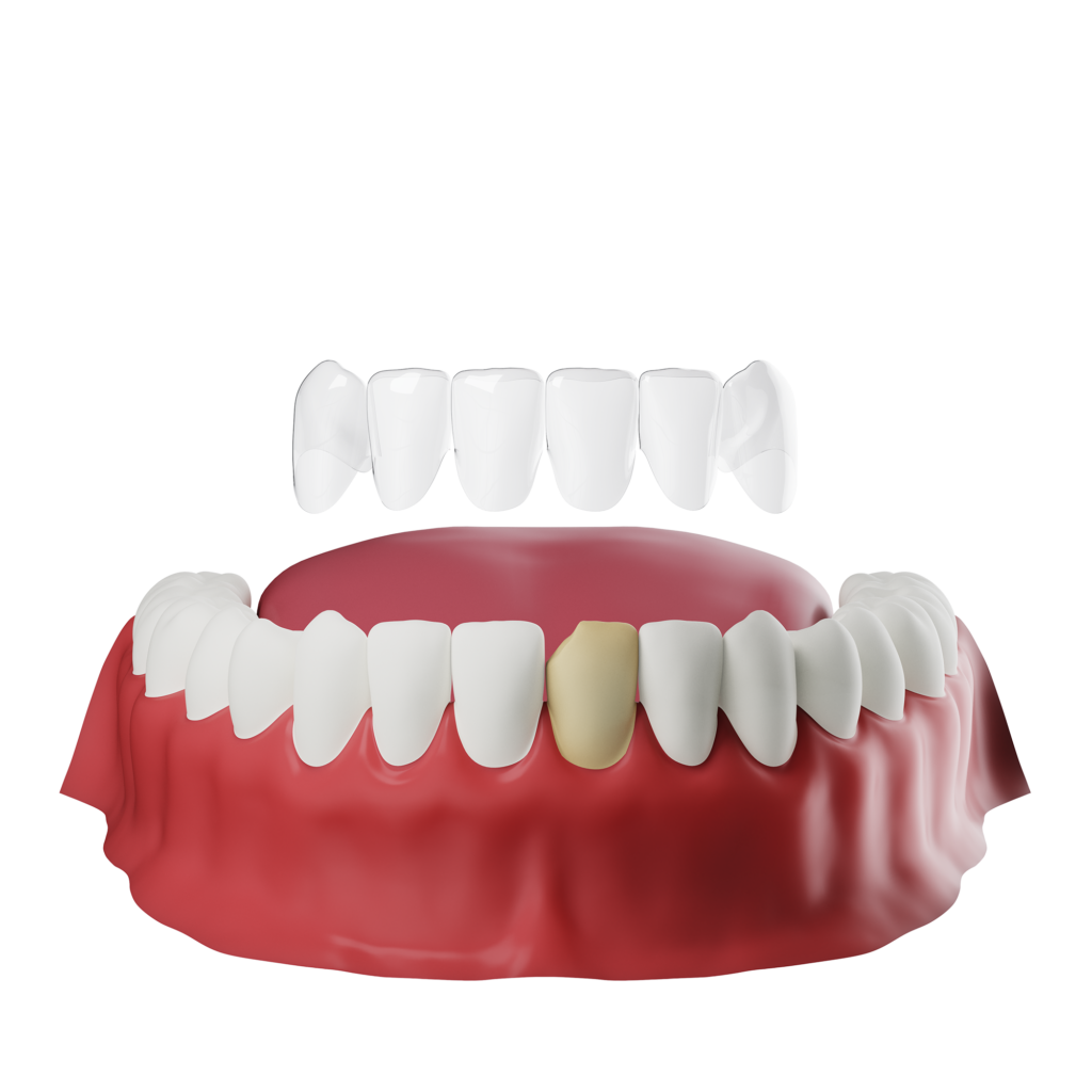 Are veneers better than Invisalign? Dental News Network