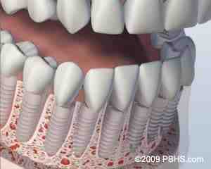 How long before you can eat after implant surgery?