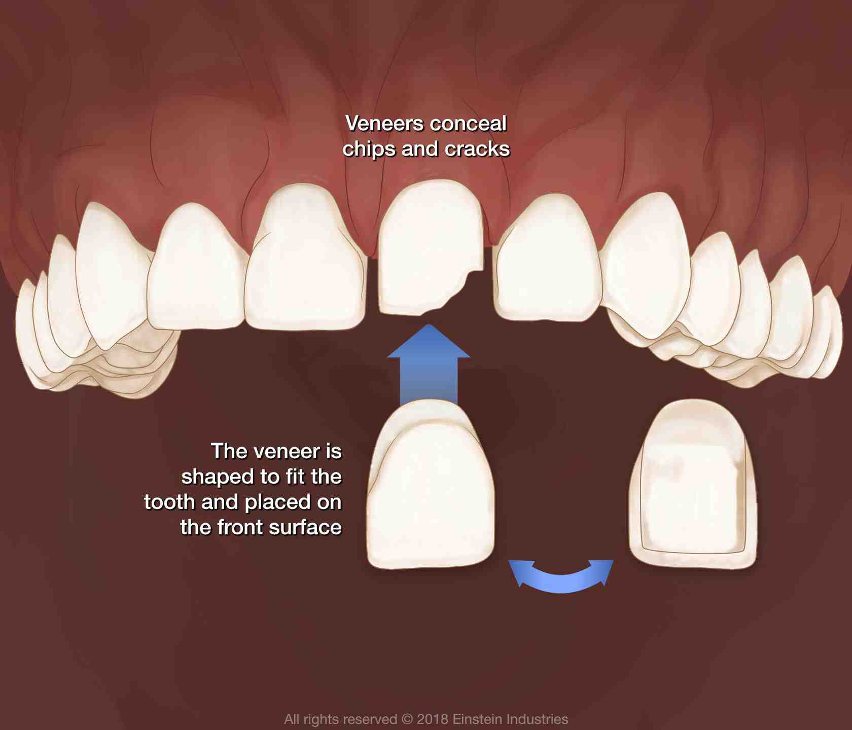 How Long Do Dental Veneers Last Dental News Network