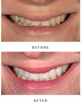 How long do dental veneers last?