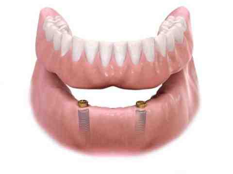 How long do mini dental implants last?