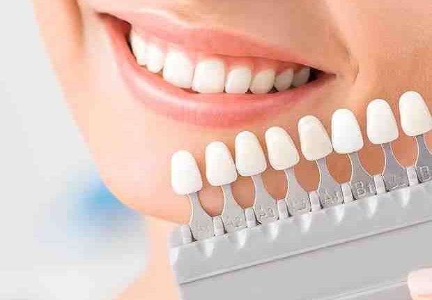 How long do tooth veneers last?