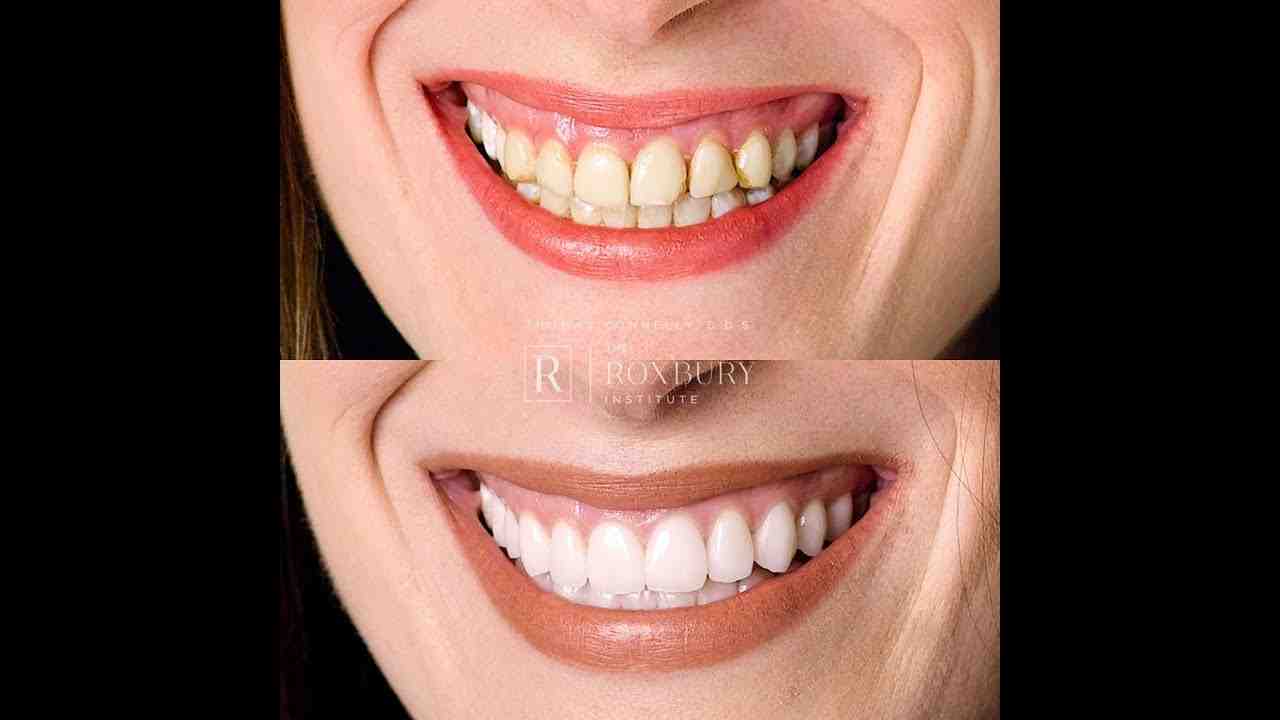 How Long Do Dental Veneers Last Dental News Network