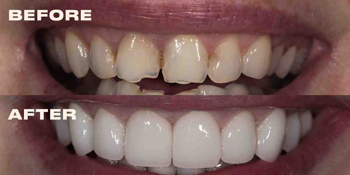How long do veneers take to heal?
