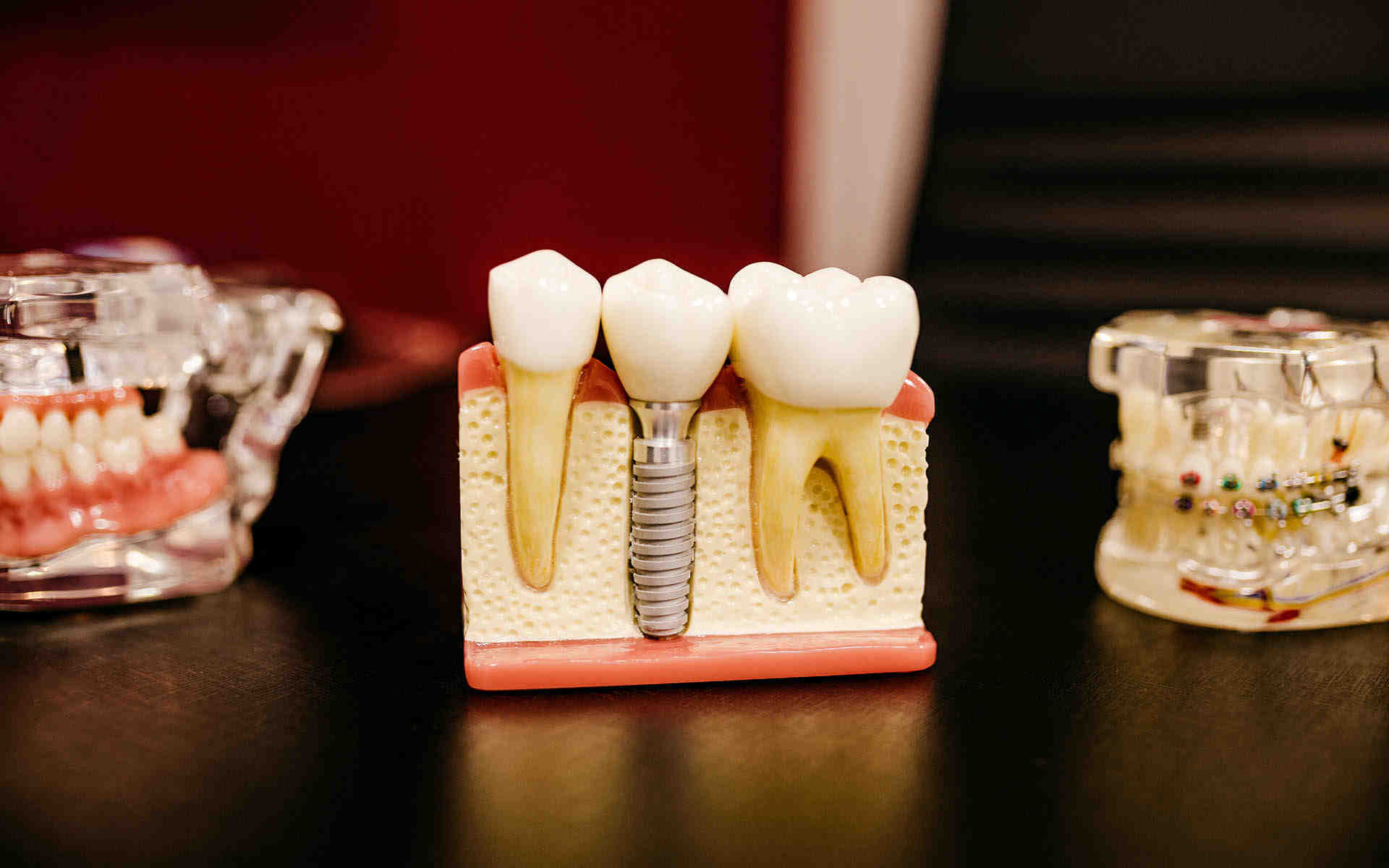 How long does a bone graft last without an implant?
