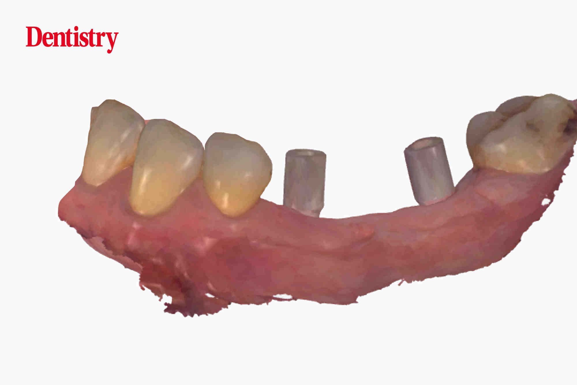 what-is-a-dental-ct-scan-with-pictures