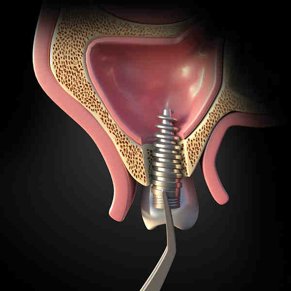 What if dental implant goes in sinus cavity Dental News Network