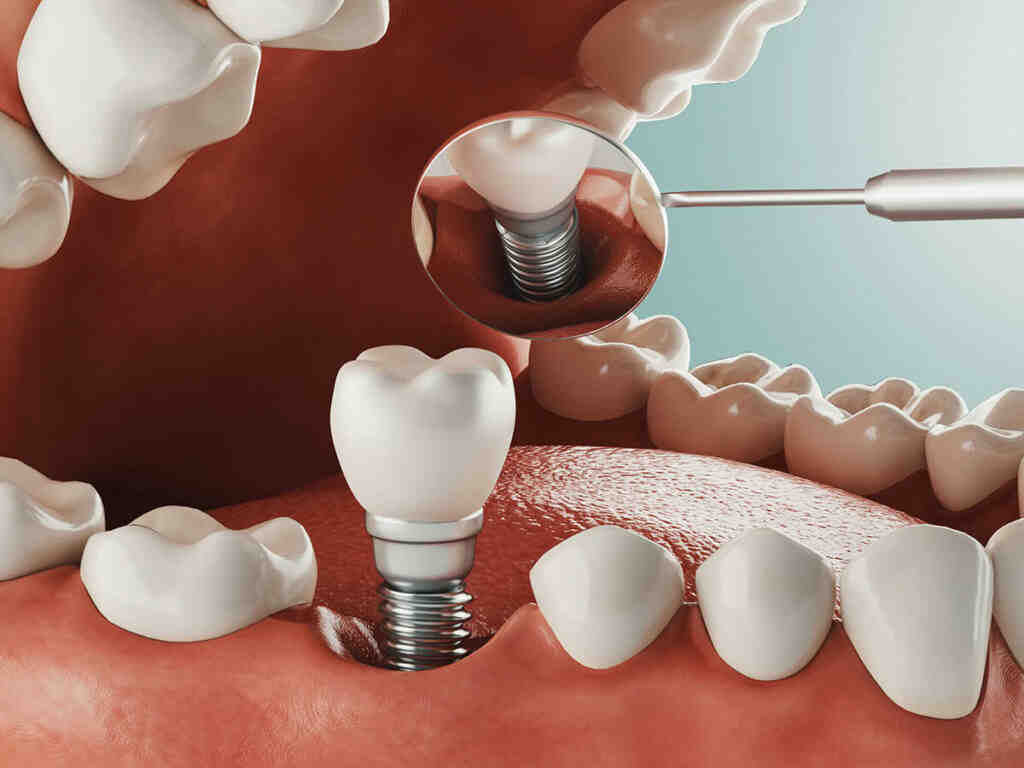 How long does dental implant surgery take for 2 teeth?