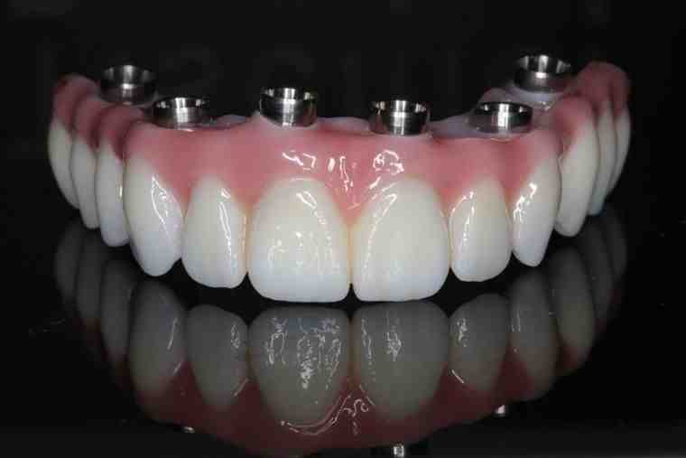 How long does it take for a dental implant to fail?
