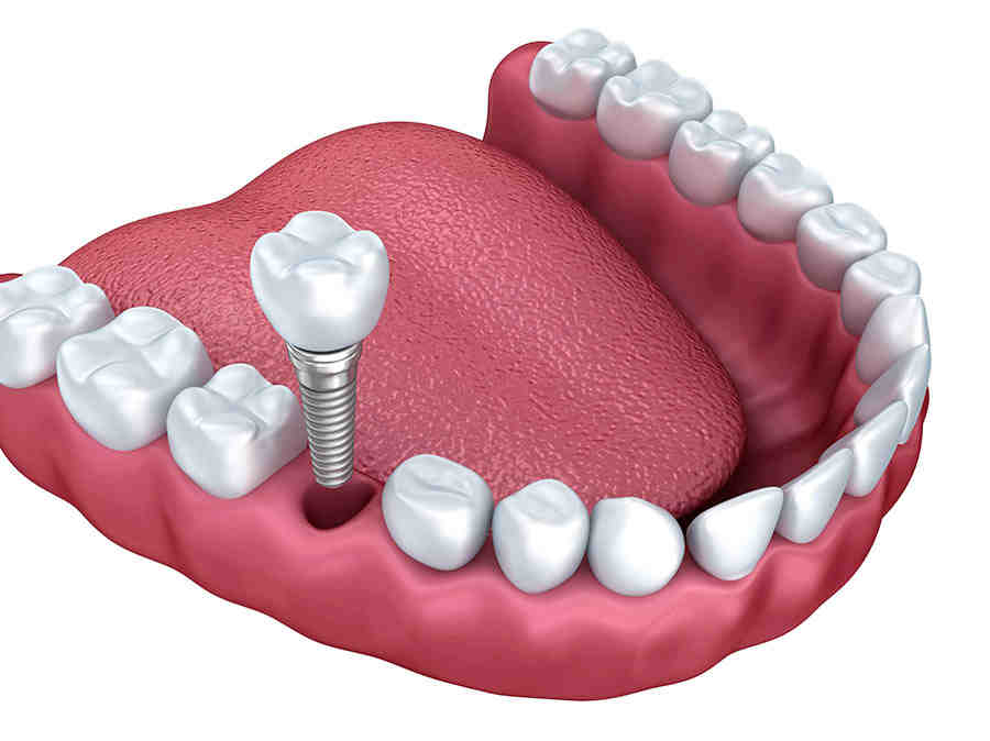 Has anyone eever had problems with their dental implants Dental News