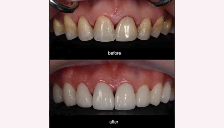 How long does it take to put veneers on?