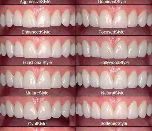 How long does porcelain veneers last?