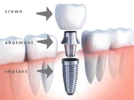 How long does two dental implants take?
