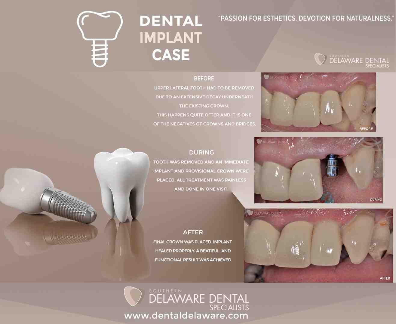 How long does your mouth hurt after a dental implant?